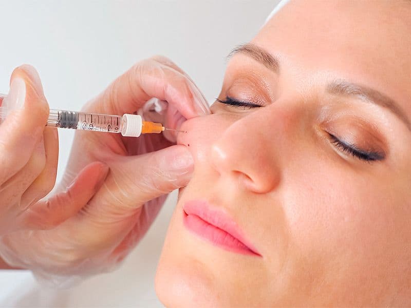 Preenchimento com Ácido Hialurônico - O preenchimento com ácido hialurônico restaura volume, suavi...