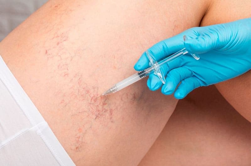 Tratamento para Microvasos (PEIM) - O PEIM (Procedimento Estético Injetável para Microvasos) é u...